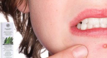 Aggiornamento situazione acne