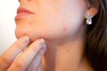 Pulizia della pelle acneica super efficace in soli 5 step!