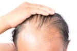 Alopecia androgenetica, nascondiamola con la tricopigmentazione