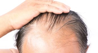 Alopecia androgenetica, nascondiamola con la tricopigmentazione